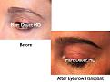 Click image for larger version

Name:	Hair Transplant Slides.594.jpg
Views:	770
Size:	63.9 KB
ID:	471440
