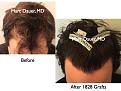 Click image for larger version

Name:	Hair Transplant Slides.608.jpg
Views:	361
Size:	79.7 KB
ID:	471494