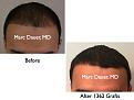 Click image for larger version

Name:	Hair Transplant Slides.597.jpg
Views:	418
Size:	52.9 KB
ID:	471506