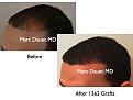 Click image for larger version

Name:	Hair Transplant Slides.598.jpg
Views:	407
Size:	55.2 KB
ID:	471507