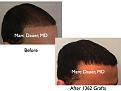 Click image for larger version

Name:	Hair Transplant Slides.599.jpg
Views:	337
Size:	55.7 KB
ID:	471508