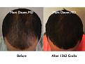 Click image for larger version

Name:	Hair Transplant Slides.600.jpg
Views:	602
Size:	69.7 KB
ID:	471509