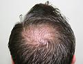 Click image for larger version

Name:	mm immediate post-op crown.jpg
Views:	284
Size:	94.4 KB
ID:	471613