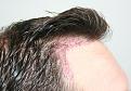 Click image for larger version

Name:	mm immediate post-op R profile.jpg
Views:	284
Size:	92.3 KB
ID:	471615