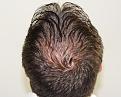 Click image for larger version

Name:	mm 1 year post-op crown.jpg
Views:	303
Size:	95.8 KB
ID:	471617