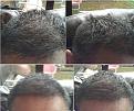 Click image for larger version

Name:	1o. 5 Month Post FUE B.jpg
Views:	1092
Size:	95.4 KB
ID:	471677