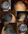 Click image for larger version

Name:	1. Day Before FUE.jpg
Views:	1147
Size:	96.1 KB
ID:	471678