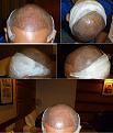 Click image for larger version

Name:	1b. Day 2 Post FUE.jpg
Views:	977
Size:	76.4 KB
ID:	471679