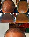 Click image for larger version

Name:	1g. Day 10 Post FUE.jpg
Views:	1020
Size:	73.5 KB
ID:	471680
