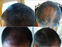 Click image for larger version

Name:	1k. 3 Month Post FUE.jpg
Views:	1020
Size:	96.0 KB
ID:	471681