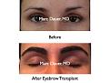 Click image for larger version

Name:	Hair Transplant Slides.624.jpg
Views:	352
Size:	57.4 KB
ID:	471765