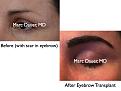 Click image for larger version

Name:	Hair Transplant Slides.625.jpg
Views:	463
Size:	59.4 KB
ID:	471766
