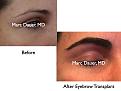 Click image for larger version

Name:	Hair Transplant Slides.626.jpg
Views:	587
Size:	58.9 KB
ID:	471767