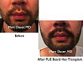 Click image for larger version

Name:	Hair Transplant Slides.637.jpg
Views:	476
Size:	74.4 KB
ID:	473367