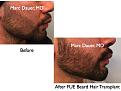 Click image for larger version

Name:	Hair Transplant Slides.638.jpg
Views:	489
Size:	71.6 KB
ID:	473368