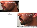 Click image for larger version

Name:	Hair Transplant Slides.639.jpg
Views:	476
Size:	62.8 KB
ID:	473369