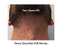 Click image for larger version

Name:	Hair Transplant Slides.640.jpg
Views:	437
Size:	68.2 KB
ID:	473370