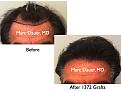 Click image for larger version

Name:	Hair Transplant Slides.641.jpg
Views:	357
Size:	64.7 KB
ID:	473423