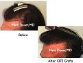 Click image for larger version

Name:	Hair Transplant Slides.642.jpg
Views:	326
Size:	63.4 KB
ID:	473424