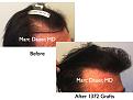 Click image for larger version

Name:	Hair Transplant Slides.643.jpg
Views:	320
Size:	63.9 KB
ID:	473425