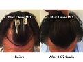 Click image for larger version

Name:	Hair Transplant Slides.644.jpg
Views:	356
Size:	76.6 KB
ID:	473426