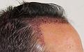 Click image for larger version

Name:	bm immediate post-op R profile.jpg
Views:	693
Size:	96.8 KB
ID:	473487
