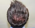Click image for larger version

Name:	bm 6 montths post-op chin up.jpg
Views:	534
Size:	89.2 KB
ID:	473492