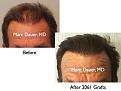 Click image for larger version

Name:	Hair Transplant Slides.646.jpg
Views:	448
Size:	66.5 KB
ID:	473494