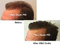 Click image for larger version

Name:	Hair Transplant Slides.647.jpg
Views:	287
Size:	60.8 KB
ID:	473495