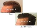 Click image for larger version

Name:	Hair Transplant Slides.647.jpg
Views:	409
Size:	60.8 KB
ID:	473495
