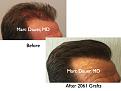Click image for larger version

Name:	Hair Transplant Slides.648.jpg
Views:	440
Size:	67.2 KB
ID:	473496