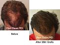 Click image for larger version

Name:	Hair Transplant Slides.649.jpg
Views:	443
Size:	81.5 KB
ID:	473497