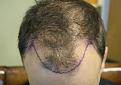 Click image for larger version

Name:	CA, pre-op.jpg
Views:	545
Size:	45.1 KB
ID:	473543