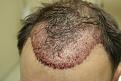 Click image for larger version

Name:	CA, immediate post-op.jpg
Views:	511
Size:	48.3 KB
ID:	473544