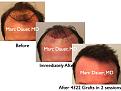 Click image for larger version

Name:	Hair Transplant Slides.655.jpg
Views:	317
Size:	66.8 KB
ID:	473612