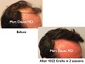Click image for larger version

Name:	Hair Transplant Slides.656.jpg
Views:	365
Size:	63.8 KB
ID:	473613