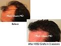 Click image for larger version

Name:	Hair Transplant Slides.657.jpg
Views:	299
Size:	61.9 KB
ID:	473614