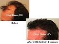 Click image for larger version

Name:	Hair Transplant Slides.657.jpg
Views:	373
Size:	61.9 KB
ID:	473614