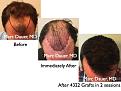 Click image for larger version

Name:	Hair Transplant Slides.658.jpg
Views:	334
Size:	73.2 KB
ID:	473615