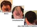Click image for larger version

Name:	Hair Transplant Slides.658.jpg
Views:	412
Size:	73.2 KB
ID:	473615