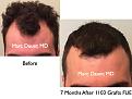 Click image for larger version

Name:	Hair Transplant Slides.659.jpg
Views:	401
Size:	67.8 KB
ID:	473648