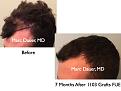 Click image for larger version

Name:	Hair Transplant Slides.660.jpg
Views:	285
Size:	61.1 KB
ID:	473649