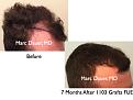 Click image for larger version

Name:	Hair Transplant Slides.661.jpg
Views:	301
Size:	65.8 KB
ID:	473650