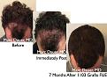 Click image for larger version

Name:	Hair Transplant Slides.662.jpg
Views:	285
Size:	81.2 KB
ID:	473651