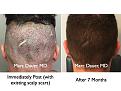 Click image for larger version

Name:	Hair Transplant Slides.663.jpg
Views:	281
Size:	92.6 KB
ID:	473652