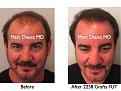 Click image for larger version

Name:	Hair Transplant Slides.667.jpg
Views:	364
Size:	74.6 KB
ID:	473824