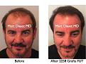 Click image for larger version

Name:	Hair Transplant Slides.667.jpg
Views:	301
Size:	74.6 KB
ID:	473824