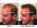 Click image for larger version

Name:	Hair Transplant Slides.668.jpg
Views:	351
Size:	71.1 KB
ID:	473825
