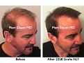 Click image for larger version

Name:	Hair Transplant Slides.669.jpg
Views:	288
Size:	77.9 KB
ID:	473826