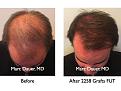 Click image for larger version

Name:	Hair Transplant Slides.670.jpg
Views:	300
Size:	70.3 KB
ID:	473827